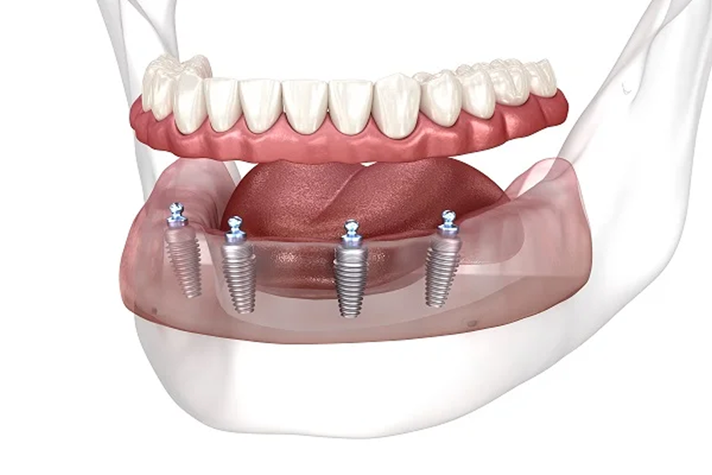 All-on-4 Dental Implants – Full Mouth
