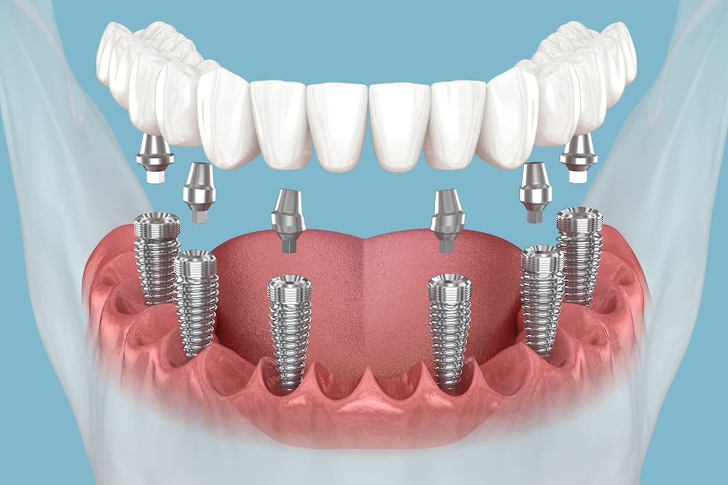 All-on-6 Dental Implants- Full Mouth