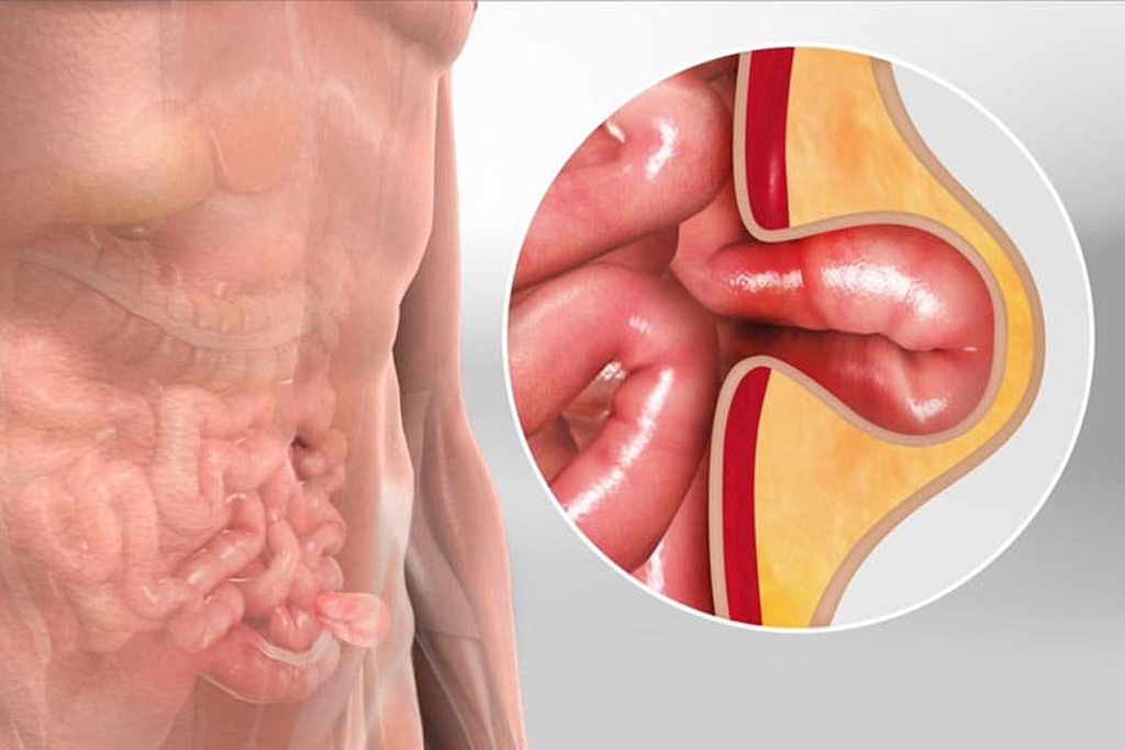 Laparoscopic Hernia Repair