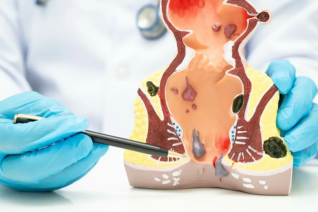 Hemorrhoids Surgery (Piles Surgery)