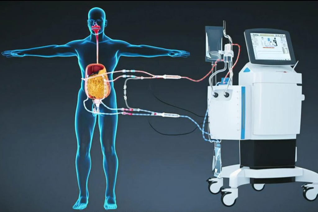 HIPEC (Hyperthermic Intraperitoneal Chemotherapy)