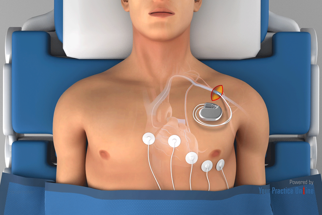 Pacemaker Implantation Surgery