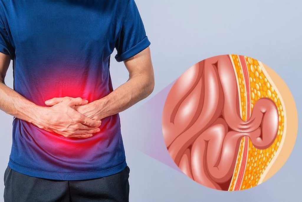 Laparoscopic Inguinal Hernia Repair (Unilateral)