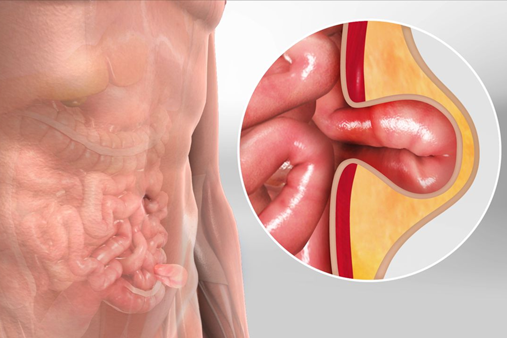 Laparoscopic Inguinal Hernia Repair (Bilateral)