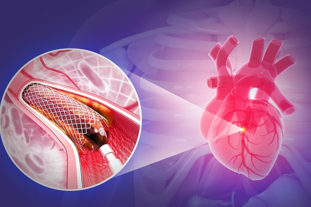 Coronary Angioplasty with 1 Stent