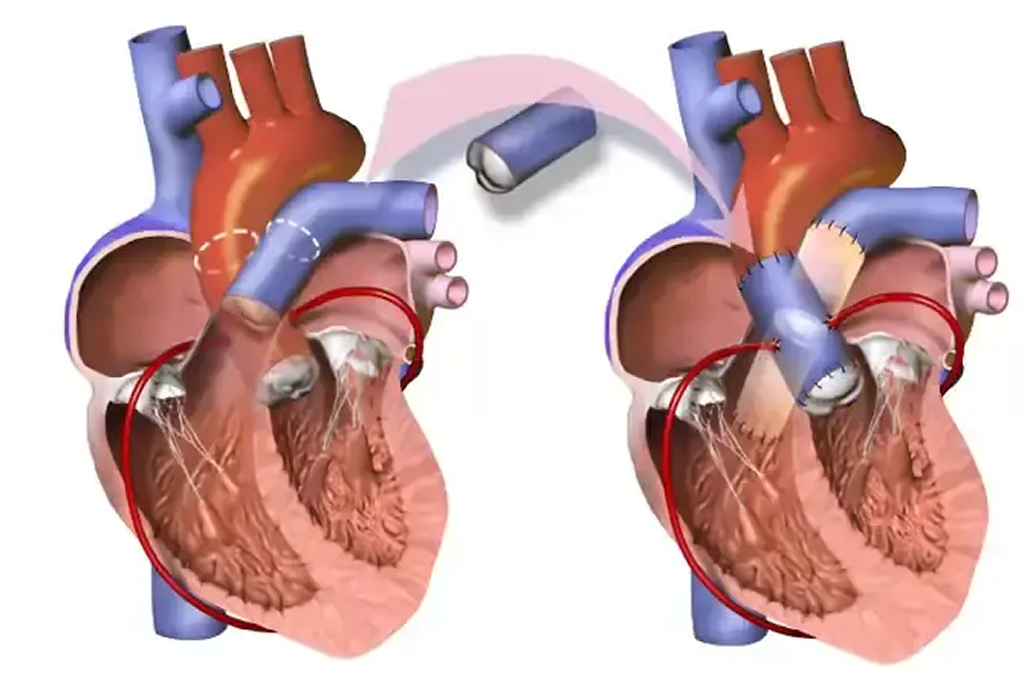 Double Valve Replacement/Repair