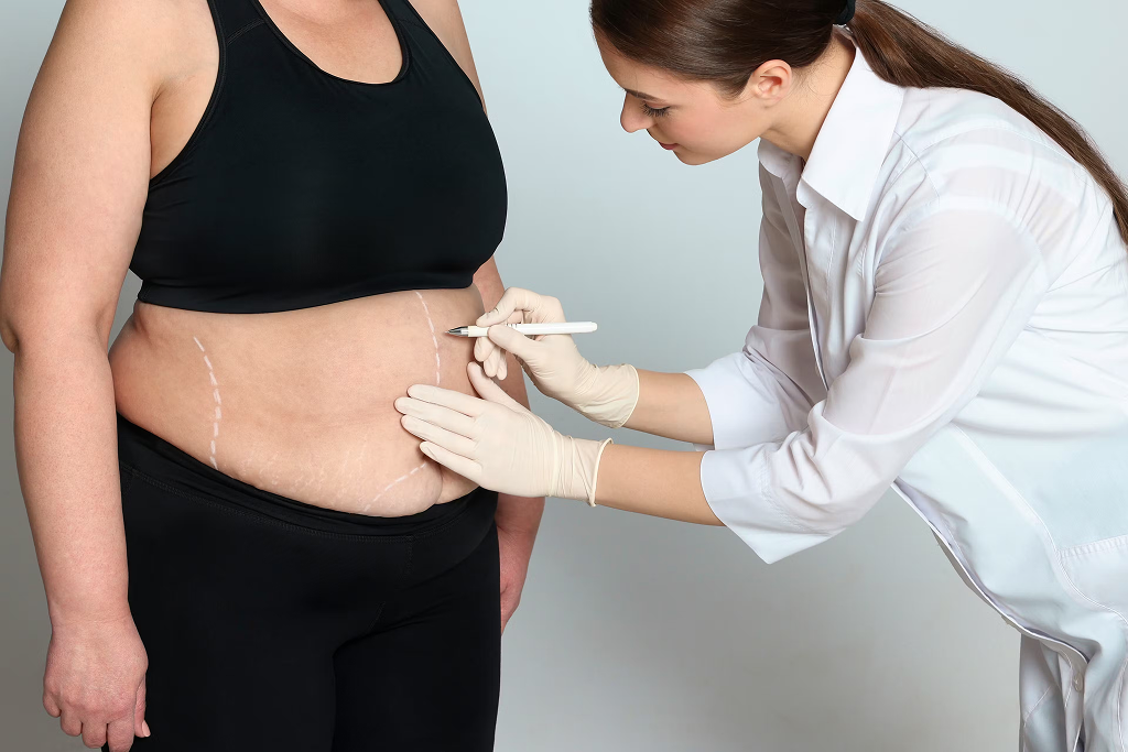 Laparoscopic Sleeve Gastrectomy