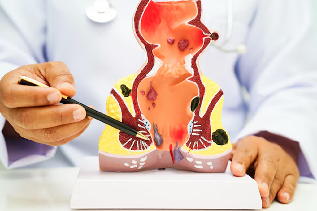Stapled Haemorrhoidectomy