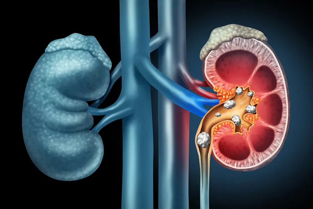 Percutaneous Nephrolithotomy (PCNL)