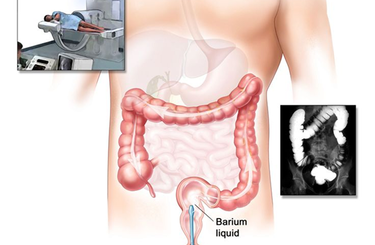 Low Anterior Resection Package in Artemis Hospital