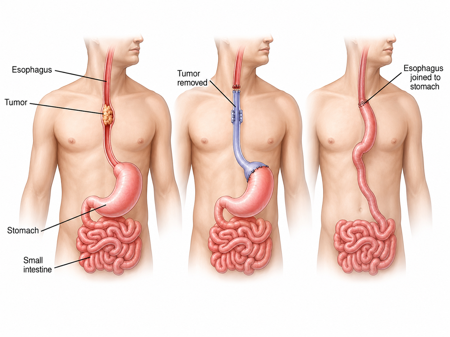 Radical Esophagectomy Package in Artemis Hospital