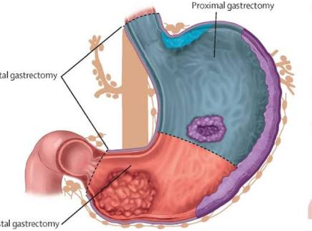Radical Gastrectomy (Total) Package in Artemis Hospital