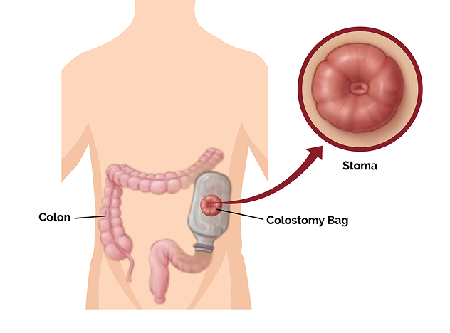 Total Colectomy Package in Artemis Hospital