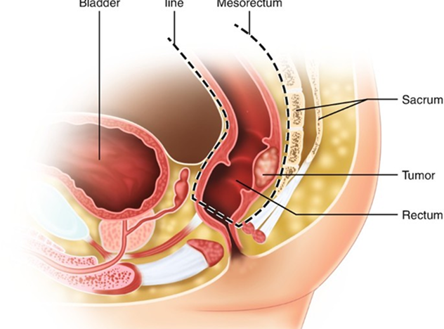 Rectum Low Anteroir Resection Package in Artemis Hospital
