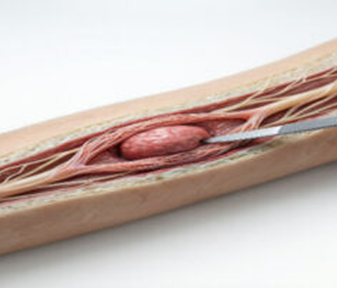 Nerve Sheath Tumor Excision Package in Artemis Hospital