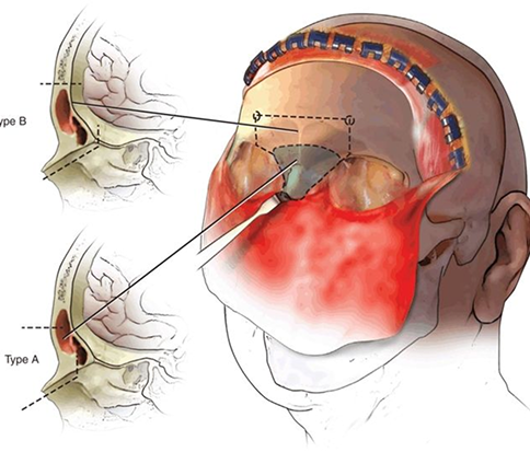 Craniofacial Resection Package in Artemis Hospital