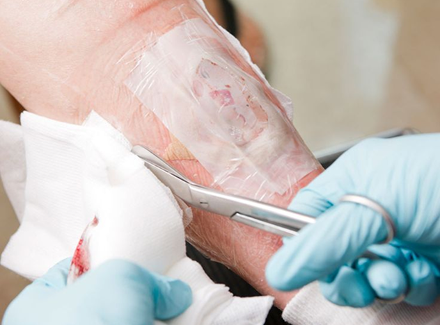 Limb Sarcoma Package in Artemis Hospital