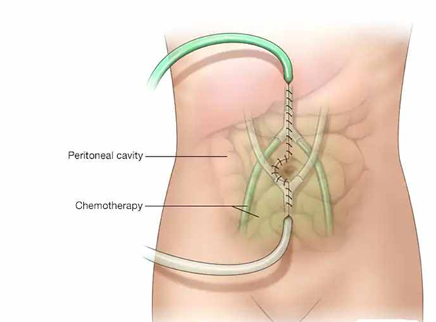 Cytoreductive Surgery + HIPEC Package in Artemis Hospital