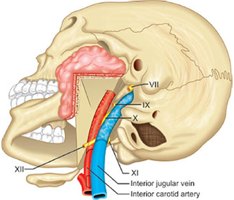 Parapharyngeal Mass Excision Package in Artemis Hospital