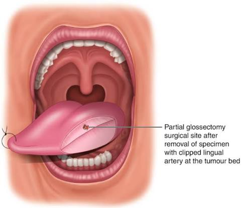 Right Radical Maxillectomy with Reconstruction Package in Artemis Hospital