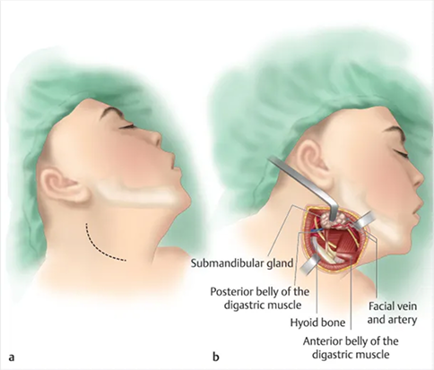 Partial Glossectomy with Neck Dissection Package in Artemis Hospital