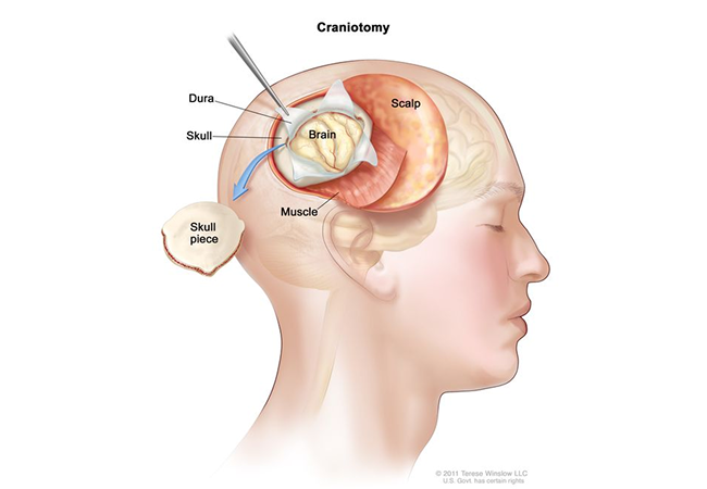 Craniotomy Package for Artemis Hospital
