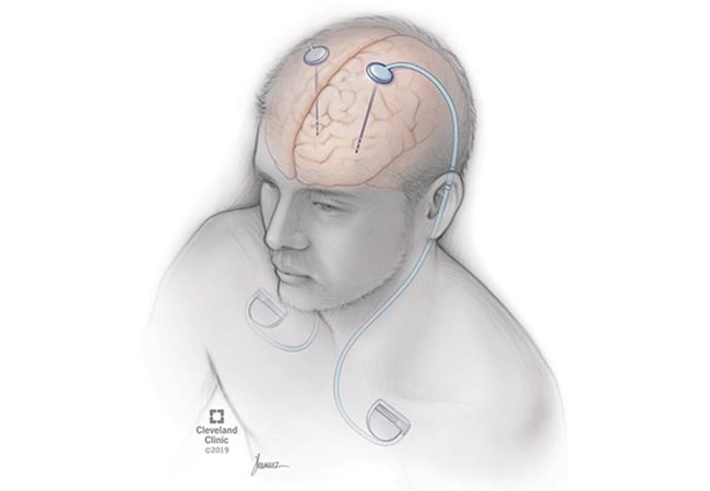 DBS (Deep Brain Stimulation) Surgery - Non Rechargeable Battery Package in Artemis Hospital