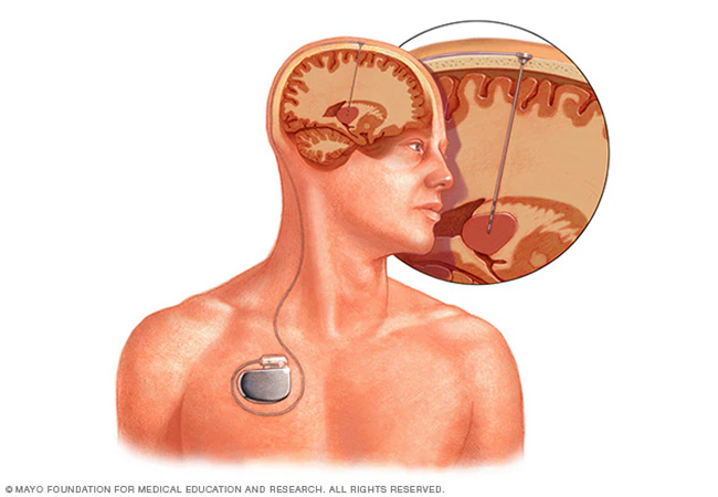 DBS (Deep Brain Stimulation) Surgery - Rechargeable Battery Package in Artemis Hospital