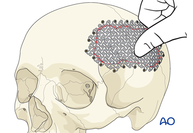 Cranioplasty Package in Artemis Hospital