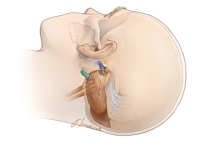 Microvascular Decompression Package in Artemis Hospital