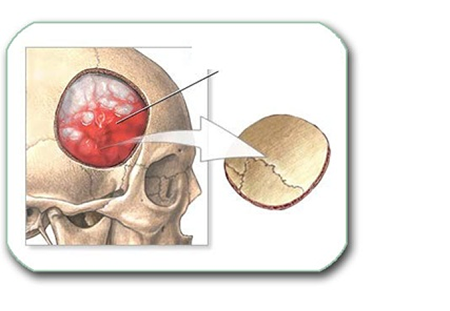 Epidural Hematoma Surgery Package in Artemis Hospital