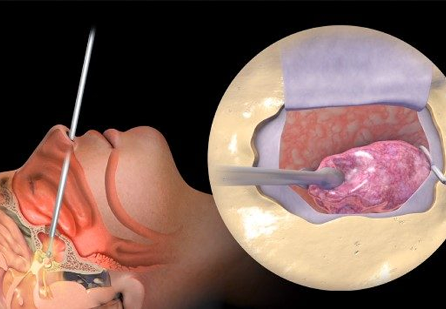 Pituitary Gland Tumor Removal Package in Artemis Hospital