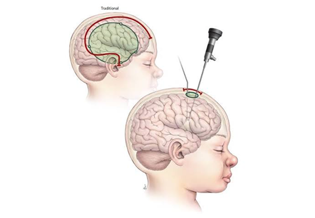 Epilepsy Surgery Package in Artemis Hospital