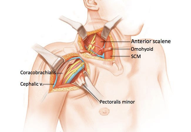 Brachial Plexus Surgery Package in Artemis Hospital