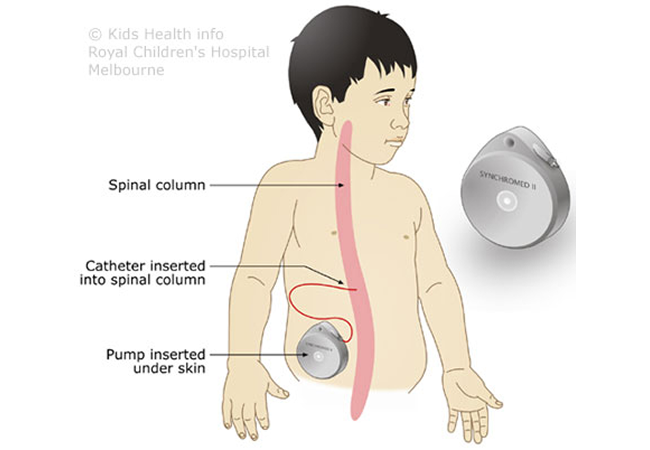 Baclofen Pump Package in Artemis Hospital