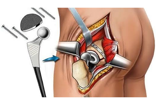 Unilateral Hip Replacement Surgery in Artemis Hospital