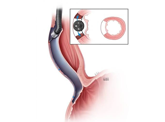 Peroral Endoscopic Myotomy (POEM) surgery Package in Artemis Hospital