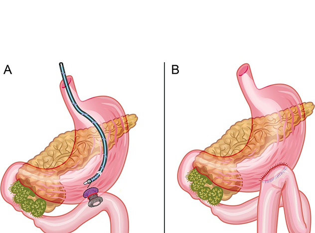 EUS Guided Gastrojejunostomy Package in Artemis Hospital