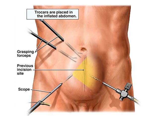 Hernia Repair Surgery (With Mesh) Package in Artemis Hospital